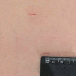 Cicatriz de pós-operatório tardio (mais de 6 meses) da simpatectomia torácica.