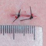 Cicatriz de pós-operatório imediato da simpatectomia torácica. O tamanho pode variar de 0.7 a 1.1cm.